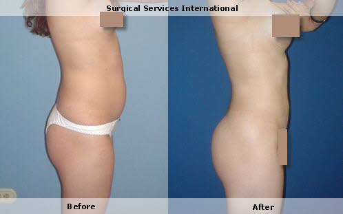 Liposuction, body contouring